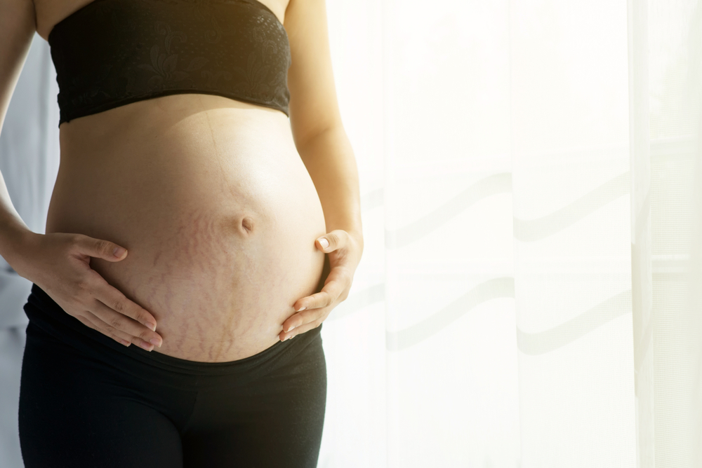 doğum, kadın, doğum sonrası, bel, göbek, çatlak, sağlık, cilt