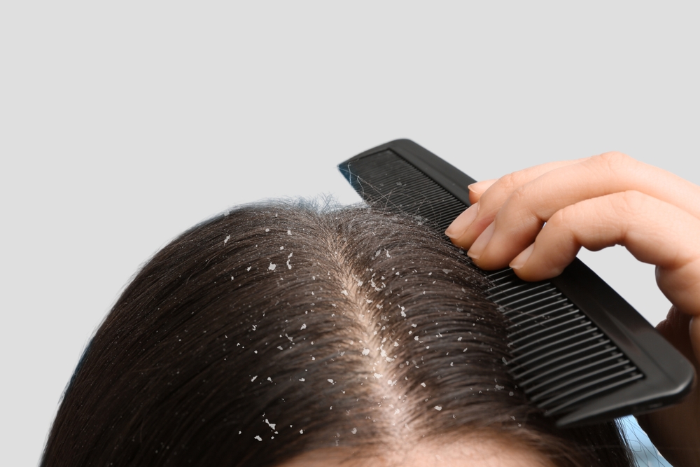 saç, saç kepeği, cilt, kafa, baş, hastalık, sağlık