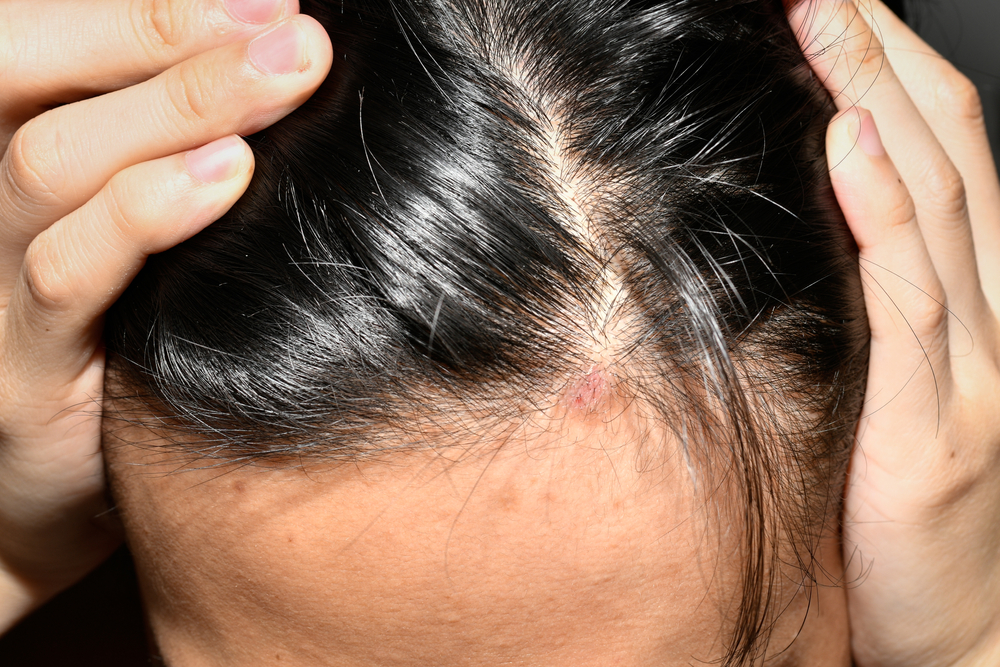 Saçkıran, saç, sağlık, hastalık, cilt