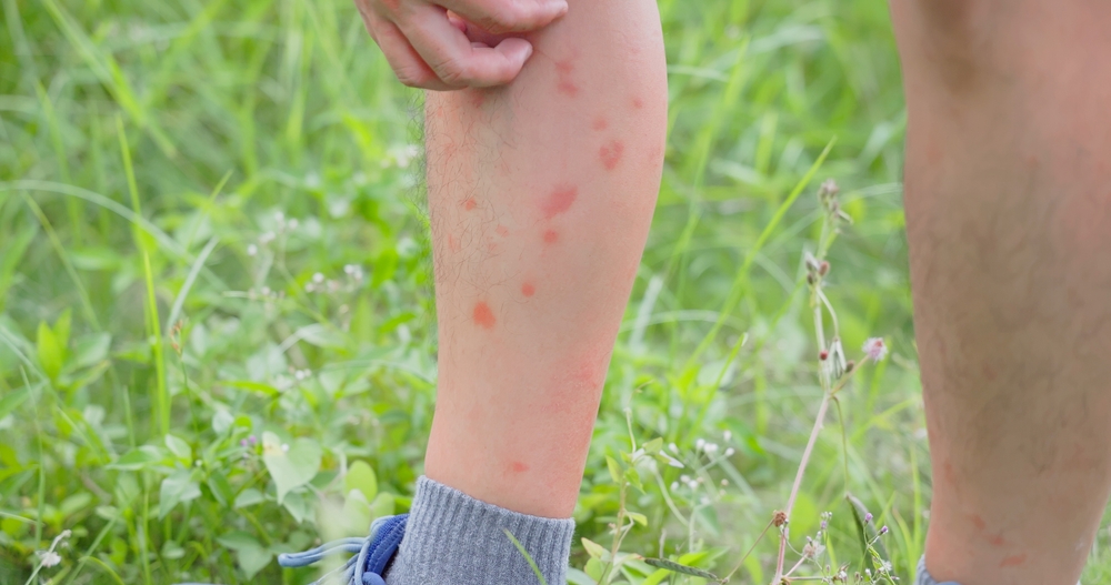 yaz, alerji, sağlık, hastalık, alerjen, bacak, yara