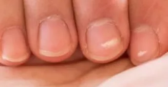 Tırnaklardaki Beyaz Lekeler Neden Oluşur, Nasıl Geçer?