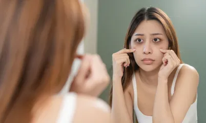 Göz Altı Morlukları İçin Neler Yapılabilir?