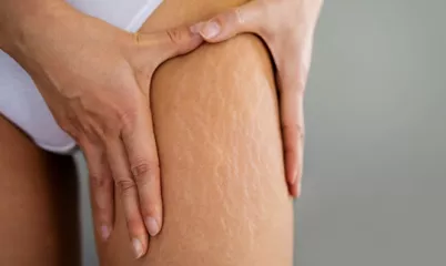 Çatlaklar İçin Doğal Yağlardan Kür Tarifleri