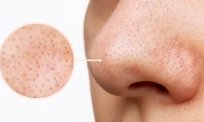 Komedon Nedir, Nasıl Temizlenir?