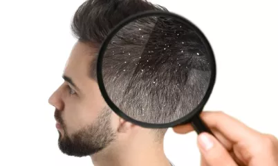 Saç Kepeğini Nasıl Engellersin?