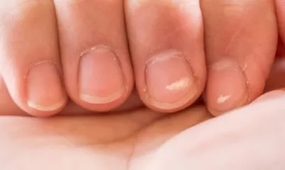 Tırnaklardaki Beyaz Lekeler Neden Oluşur, Nasıl Geçer?