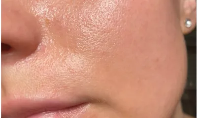 Yağ Bezeleri Nedir, Neden Çıkar, Nasıl Yok Edilir?