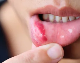 Vitamin Eksikliğinden Olan Ağız İçi Yaralara Karşı Neler Yapabilirsin?