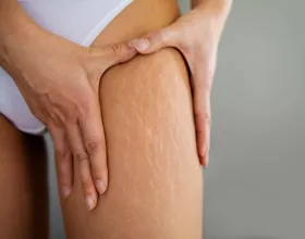 Çatlaklar İçin Doğal Yağlardan Kür Tarifleri