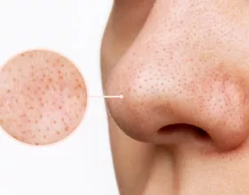 Komedon Nedir, Nasıl Temizlenir?