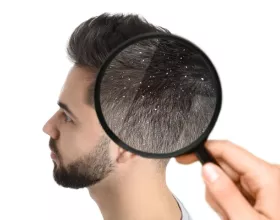 Saç Kepeğini Nasıl Engellersin?