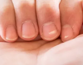 Tırnaklardaki Beyaz Lekeler Neden Oluşur, Nasıl Geçer?