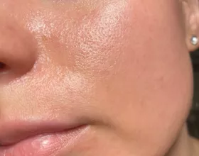 Yağ Bezeleri Nedir, Neden Çıkar, Nasıl Yok Edilir?